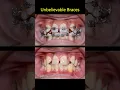 Braces unbelievable. Fix super crooked teeth. Best dentist #orthodontist #braces