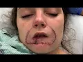Download Lagu Woman Gets Surgery to Restore Lip Her Ex-Boyfriend Bit Off