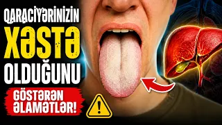 DİQQƏT! Diliniz Qaraciyəriniz Haqqında Nə Deyir? Bu Əlamətlərə Baxın