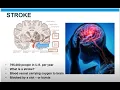 Decoding Stroke Part 1 An Introduction to Stroke
