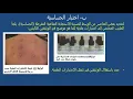 الاستجابة المناعية المفرطة  (  الحساسية )
