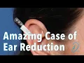 Amazing Macrotia Ear Reduction Results