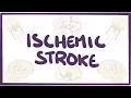 Lagu Ischemic Stroke - causes, symptoms, diagnosis, treatment, pathology