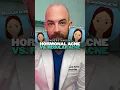 What s the difference between regular and hormonal acne Derm explains