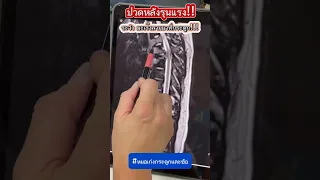  ปวดหลังรุนแรงมาก และเริ่มมีอาการอ่อนแรงขณะเดิน อาจเกิดจากสาเหตุอะไรได้บ้าง 