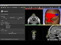 Combine patient and CAD models in 3D Slicer using difference operations