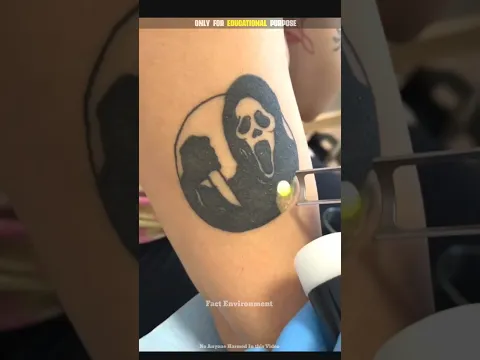 How laser remove Tattoo । #shorts
