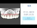 Regain 100 of Your Chewing Ability With Full Arch Dental Implant Restoration