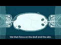 Conjoined twins separation animation