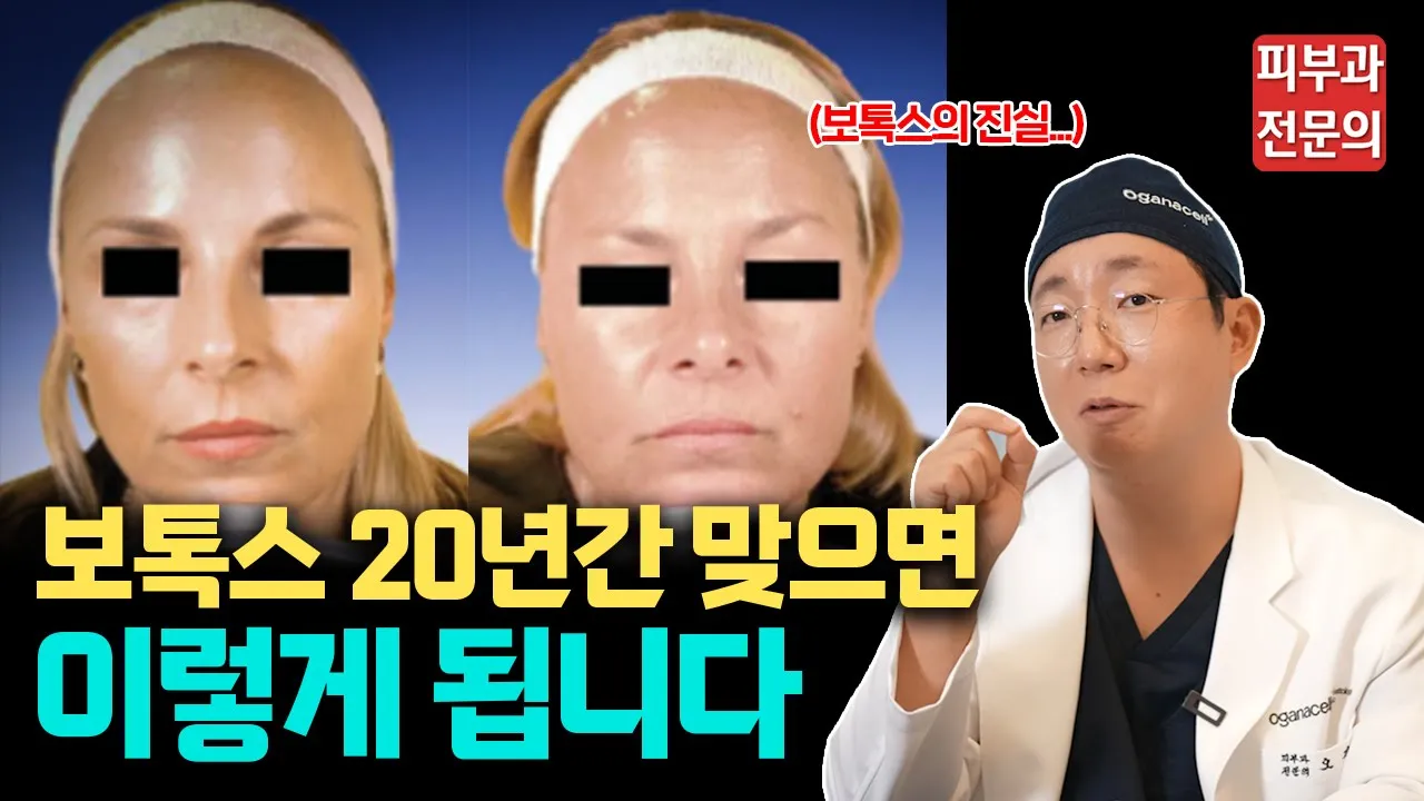 보톡스 20년간 맞았더니...헉!! / 가성비 좋은 보톡스 시술의 진실