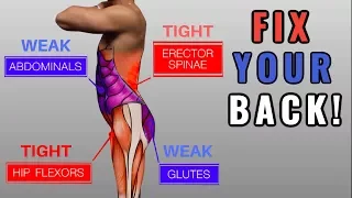 Fix Anterior Pelvic Tilt in 10 Daily Exercise Routine