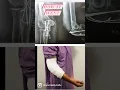 Elbow fracture - olecranon fracture