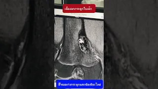  หญิงอายุ 11 ปี เจ็บเข่าด้านขวาเวลาเดินไกล ๆ แล้วตรวจพบก้อนที่กระดูก ซึ่งเป็นเนื้องอกชนิดไม่ร้ายแรง อาการปวดเกิดจากอะไร และต้องกังวลไหม 