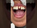 Amazing Invisible Dentistry with a Front Crown Perfect Match