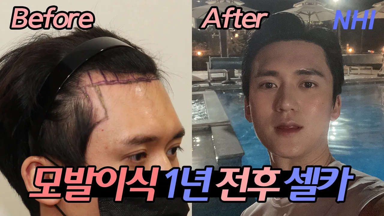 [셀카로 보는📷]남자 모발이식 전후 360일 후기ㅣ모발이식 1년경과ㅣ뉴헤어