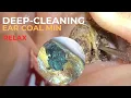 Earwax as Big as a Coal Mine - Extreme Ear Cleaning