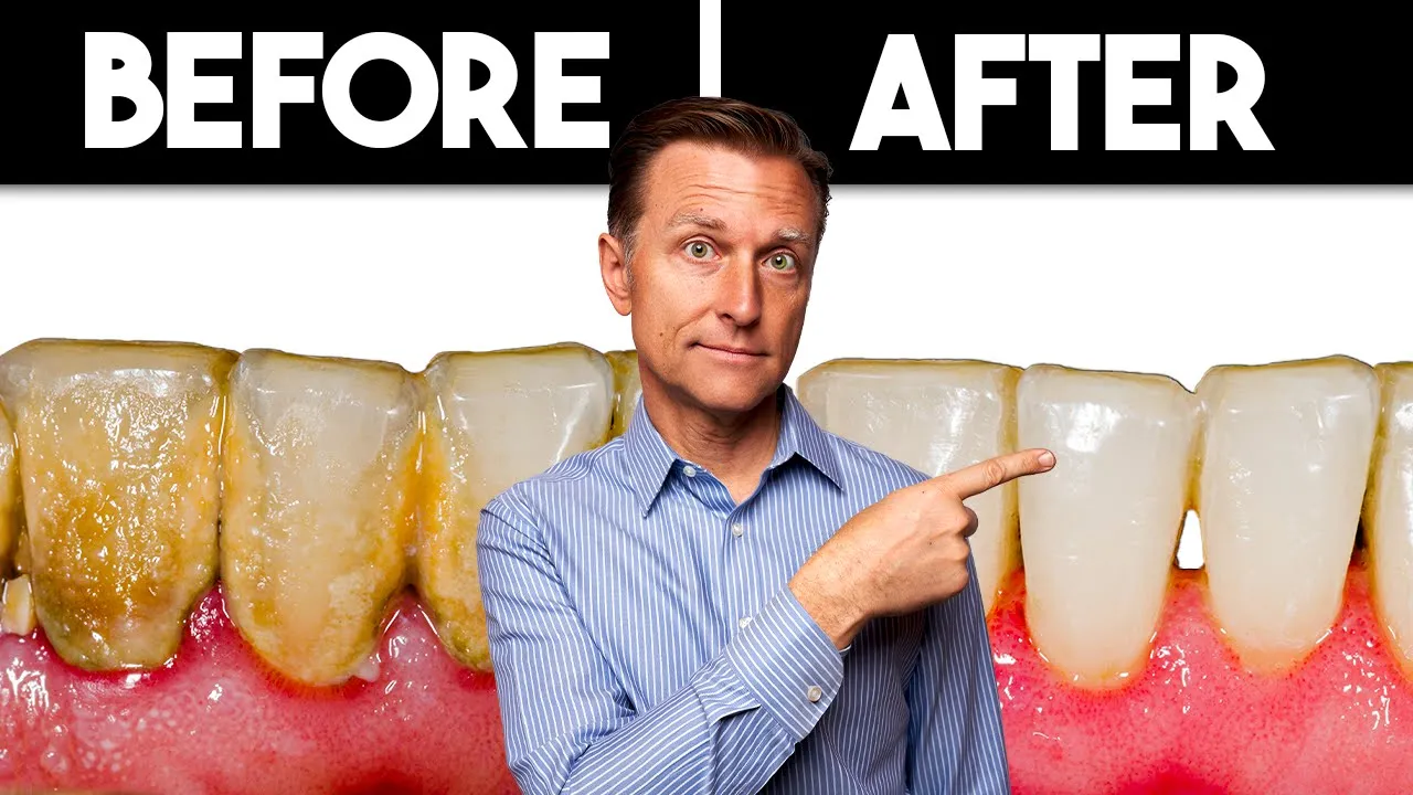 Outline Video Preventing Dental Plaque Formation Forever: Simple Solution