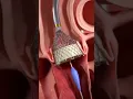 Lagu Transcatheter aortic valve implantation procedure (TAVI)