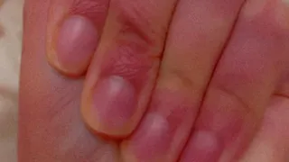 كيف تعرف اذا عندك فقر دم ولا Shorts Trending 