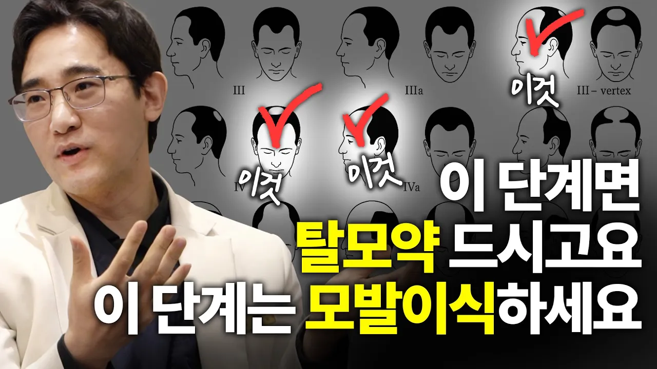 탈모 현실 조언, 모발이식할 사람, 탈모약 먹을 사람 구분법