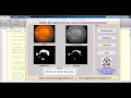 Matlab Code for Diabetic Retinopathy Detection Using CNN