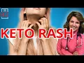 Why do you get Keto Rash and how to Cure it Dr Boz