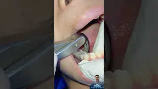 خلع اربع ضروس لبنية في جلسة واحدة                                                                  دندنها