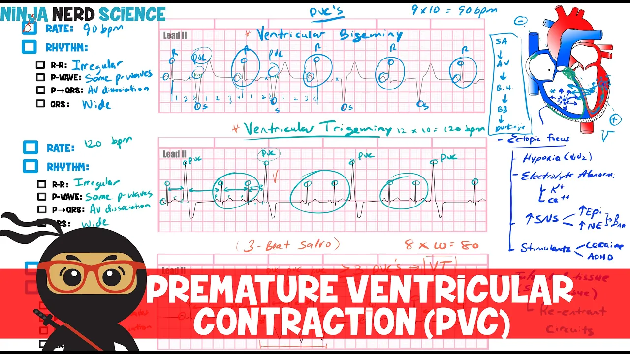 Rate and Rhythm | Premature Ventricular Contraction (PVC)