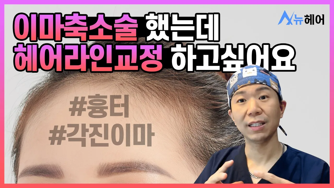 이마축소술 후 헤어라인 교정 언제 할 수 있나요? | 뉴헤어