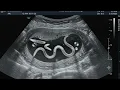 Fake Worm Ultrasound for kids prank
