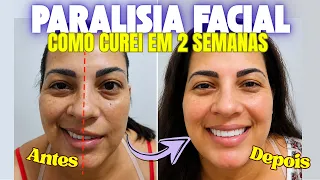 PARALISIA FACIAL: CURA EM 4 SESSÕES - DR ROMULO PIMENTA