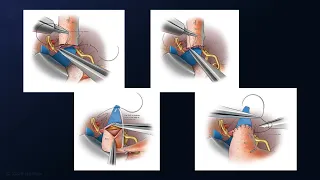 Residual Stent-Coiled Supraclinoid ICA Aneurysm with CCA-RAG-M2 Bypass and Proximal Clip Occlusion