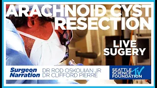 Download Arachnoid Cyst Resection - Rod J. Oskouian JR. M.D. - Narrated by Clifford Pierre, M.D. MP3