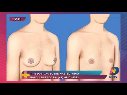 Tire dúvidas sobre mastectomia masculinizadora