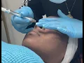 Diamond Tip Microdermabrasion w Exfoliating Peel Luxury Spa Wellness Center