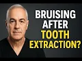 Bruising After Tooth Extraction What s Normal and When to Call Your Dentist