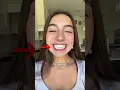 Perfect TEETH but still got braces