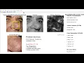Machine learning by MATLAB skin disease detection