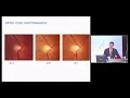 Comparison of Bruch s Membrane Minimum Width and Peripapillary Retinal Nerve Fibre Layer Thickness