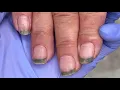 Lagu Dirty nails! There is a pile of black mud between the nails【Doctor Liu Pedicure】