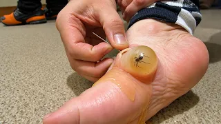 Araña llena de Pus Viviendo CarnousMente en Esta Pata de Arto Olor a Pecueca
