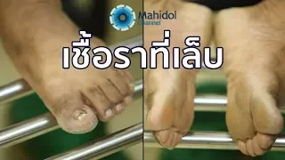  เล็บเท้าหนาขึ้นและผิวหนังที่ฝ่าเท้าลอก อาจเกิดจากสาเหตุอะไรบ้าง 