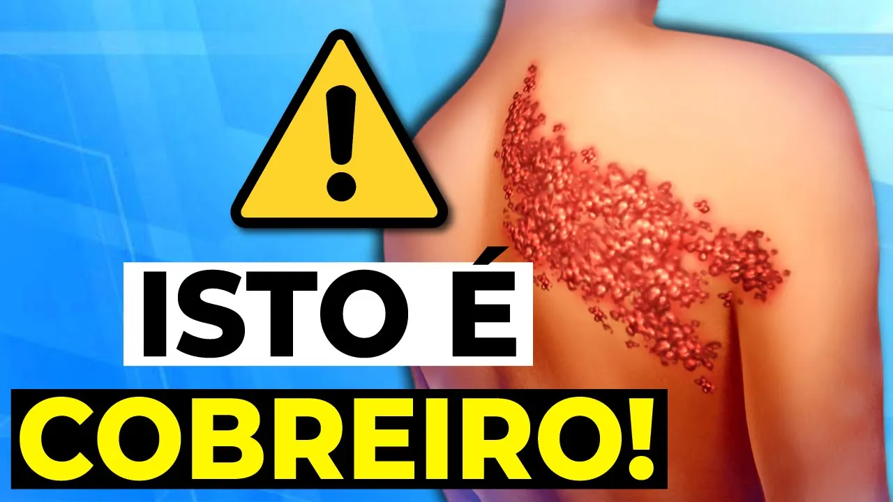 Herpes Zóster (Cobreiro) - Saiba Quais São os Sintomas e Como Prevenir