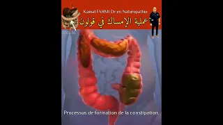 عملية الإمساك في قولون 