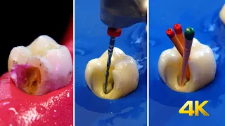 Tratamiento de conducto y restauración estética