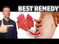 Venous Insufficiency This is the Most Effective and Safest Remedy for Varicose Veins