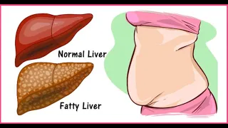 COMO EU FAÇO PARA REDUZIR BARRIGA/INCHAÇO EM 1 SEMANA!