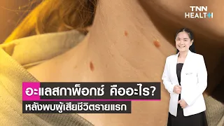 อาการของโรคอลาสก้าพเป็นอย่างไรบ้าง