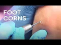 How To Fix Painful Corns Without Going to a Doctor