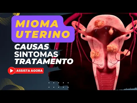 Download MP3 MIOMA UTERINO - SINTOMAS, CAUSAS E TRATAMENTO.